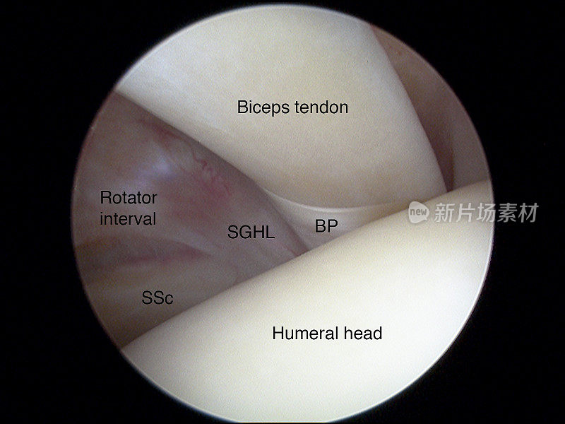 肩关节镜下二头肌腱长头图