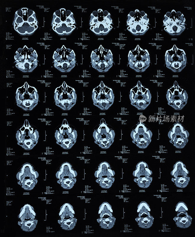 脑部断层扫描