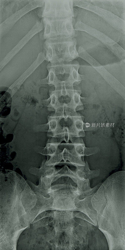 腰椎x光片-背部解剖