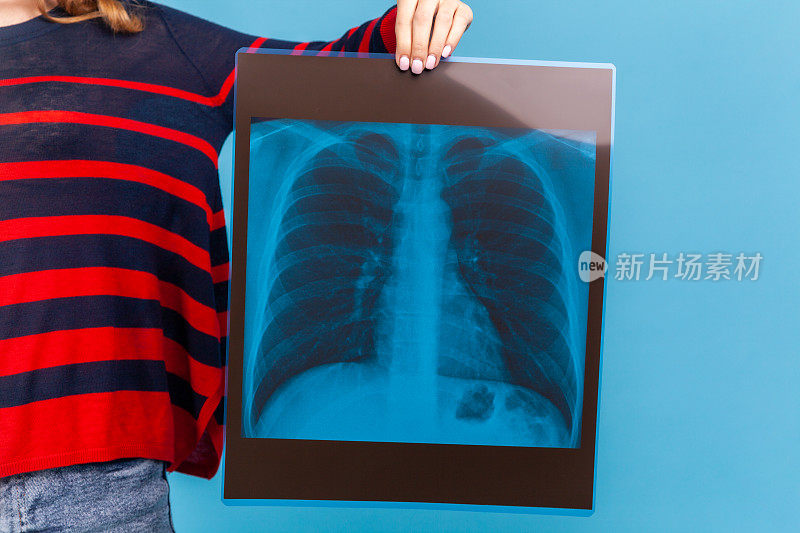不明女子手持肺部x光片，摄于患肺炎的人体肺部x光片。