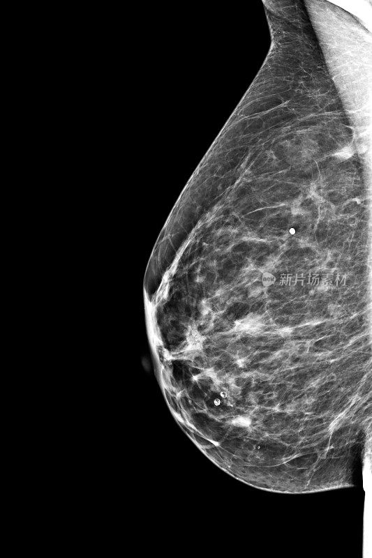 乳房乳房x光检查