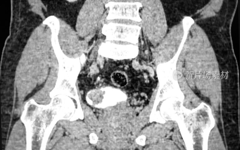 膀胱癌的CT影像