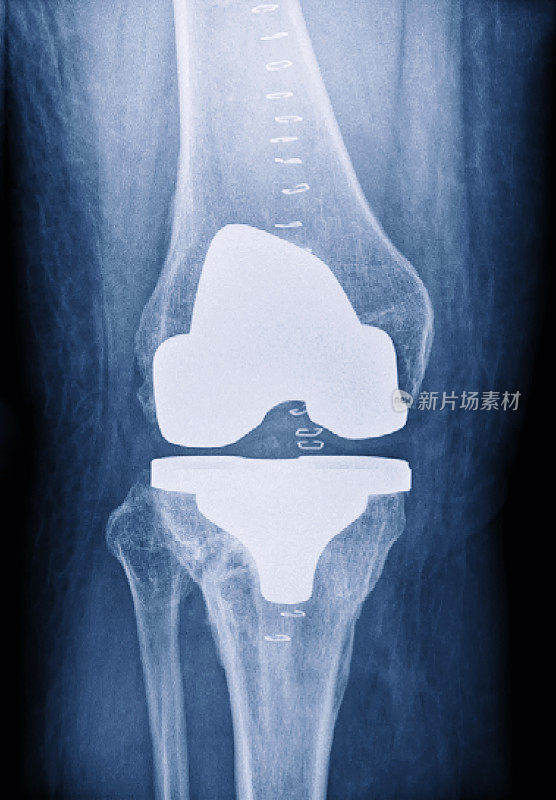 膝关节置换术成功后的x光片