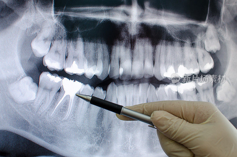 牙科医生在牙科x光图像上显示了一些东西