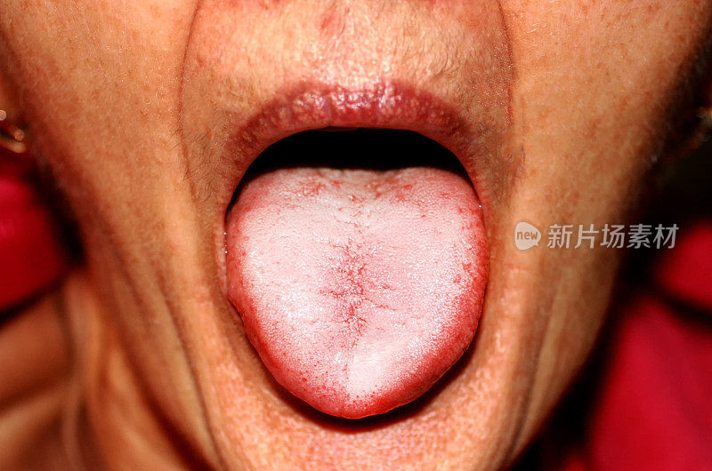 舌头呈白色。舌念珠菌病