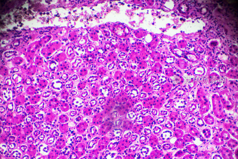显微镜下急性肾盂肾炎活检标本