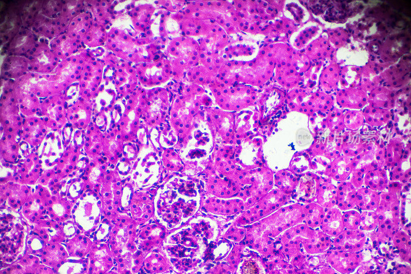 显微镜下急性肾盂肾炎活检标本