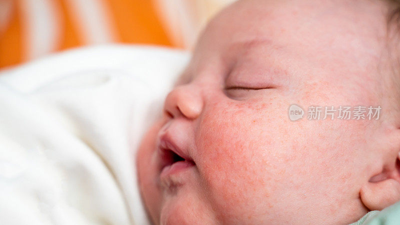 新生儿与婴儿痤疮皮肤问题的脸部特写