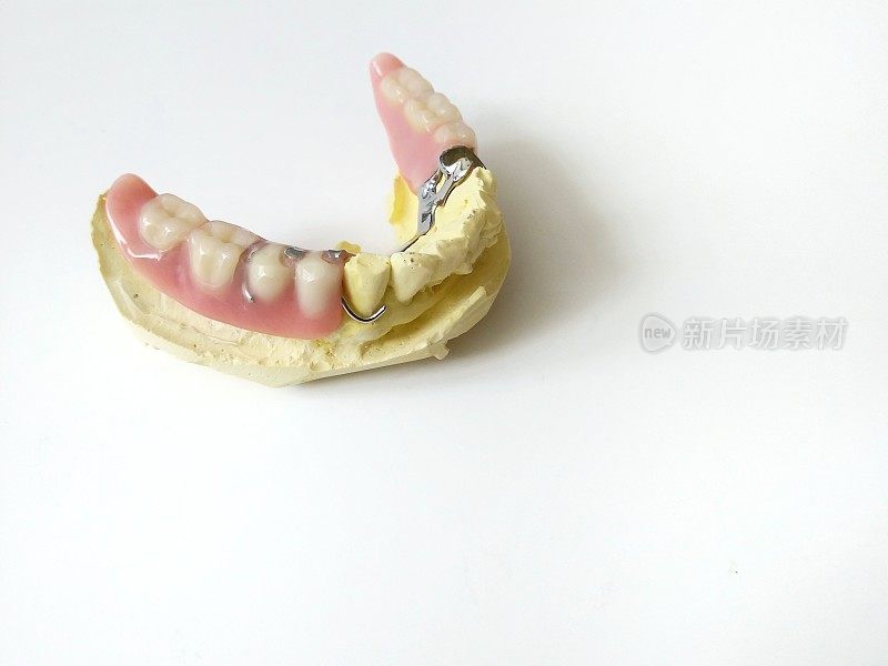 下颌VH544局部义齿