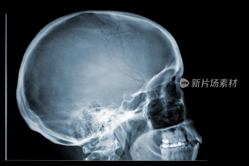 x射线颅骨侧面轮廓