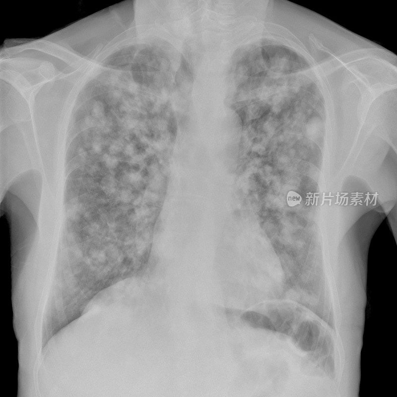 广泛性癌症中多发性肺转移的数字胸部x光片