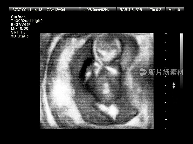 胎儿12周时的3D超声