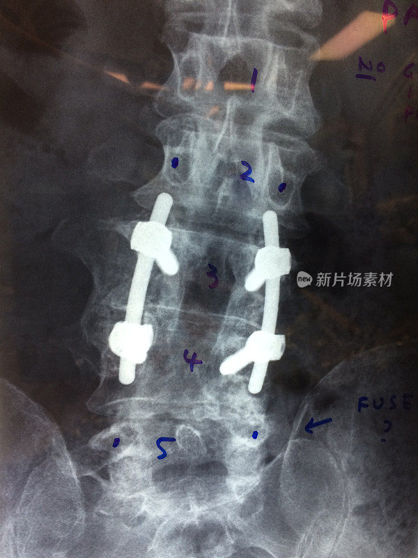 腰椎融合术