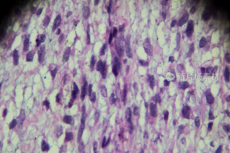 显微镜下横纹肌肉瘤活检
