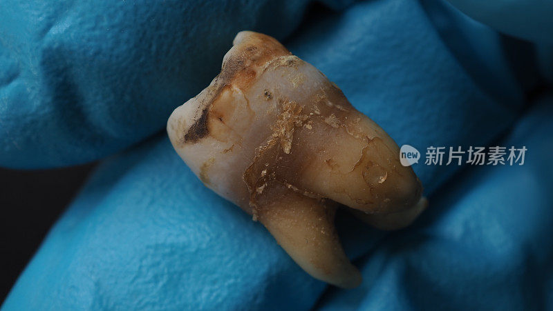 蛀牙和牙医手手套和黑色背景。牙科医生拔牙后的蛀牙至牙根的微距照片。真实的牙齿解剖，由于缺乏牙齿护理。龋齿俯视图