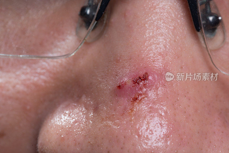生病的皮肤病，脸上有青春痘。