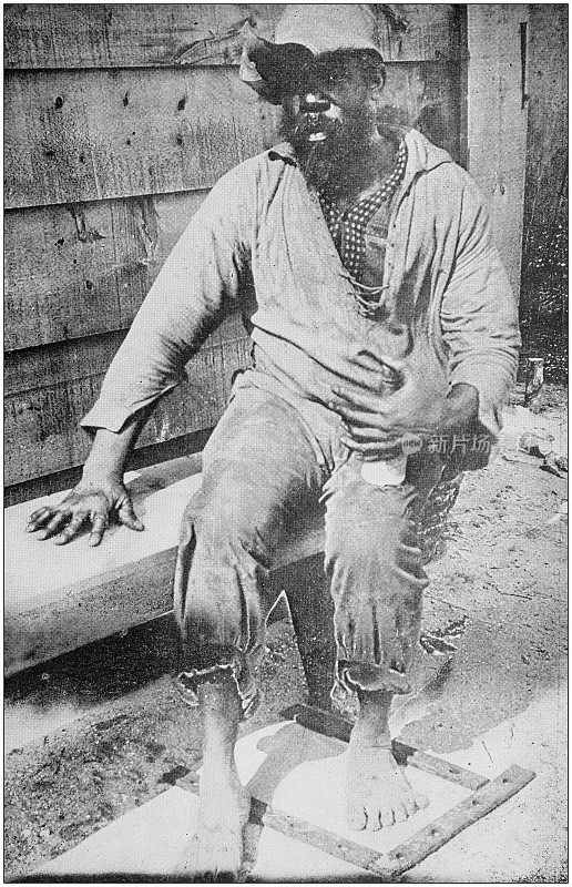美国陆军黑白照片:多了手指和脚趾的古巴乞丐