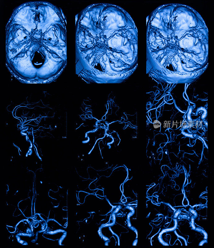 MRI扫描人脑和大脑动脉断层扫描