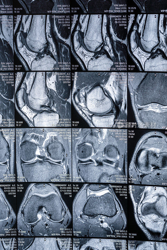 膝关节磁共振(MRI)扫描