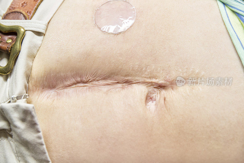 妇女胃上的手术疤痕