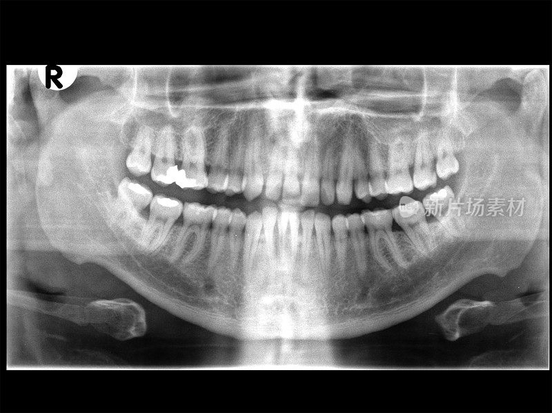 牙齿x射线图像