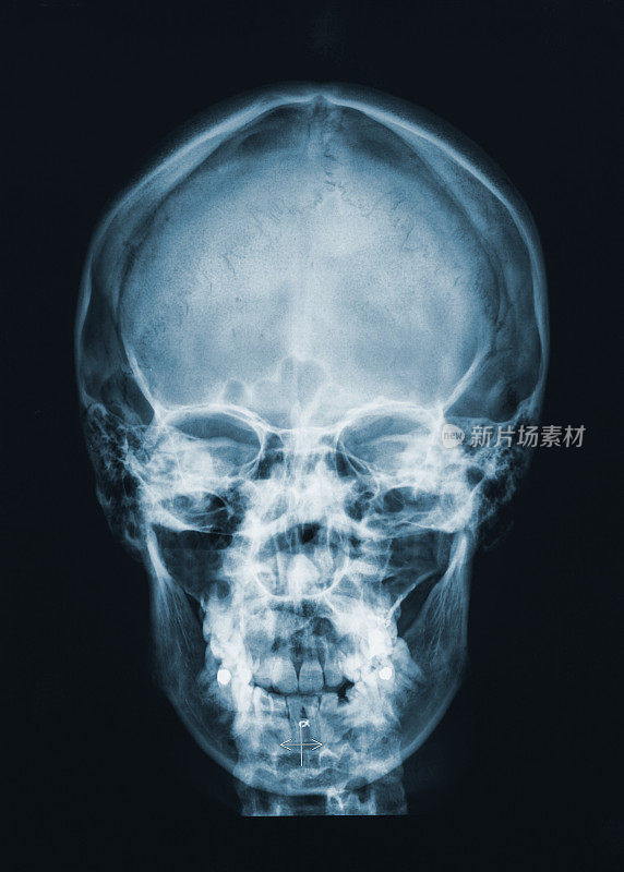 颅骨中的大脑x光片