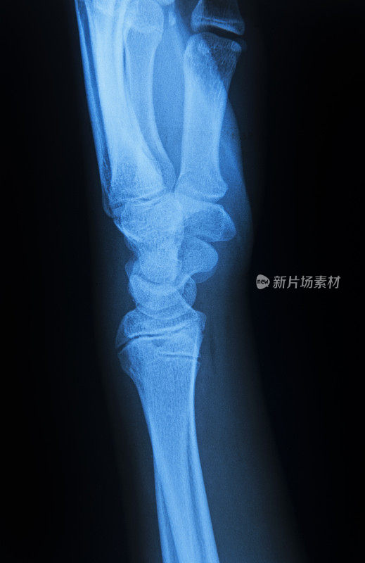 人类Handbone