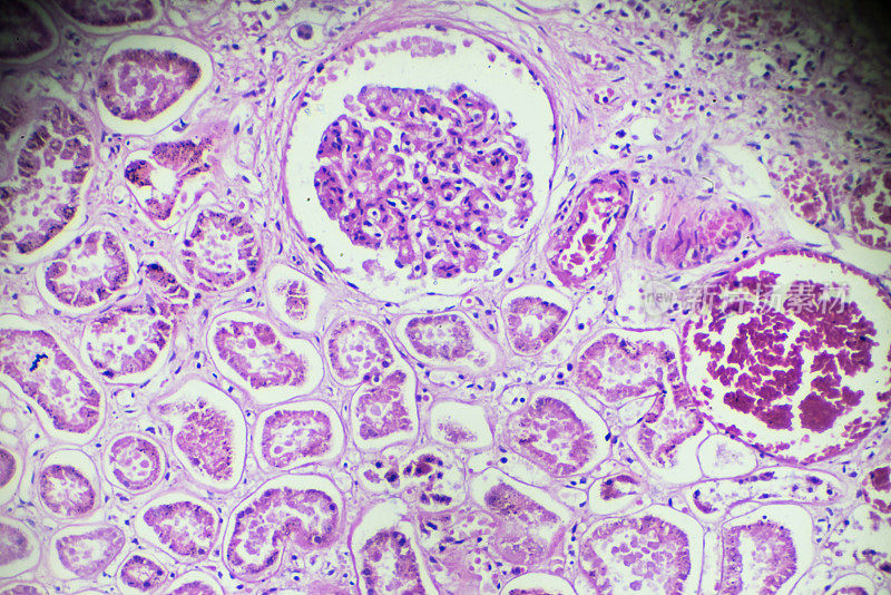 显微镜下急性肾炎活检标本