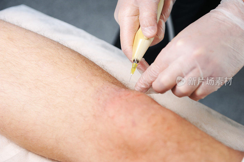 二氧化碳疗法(羧酸疗法)。皮肤恢复活力。手术是在男性的膝盖上进行的。