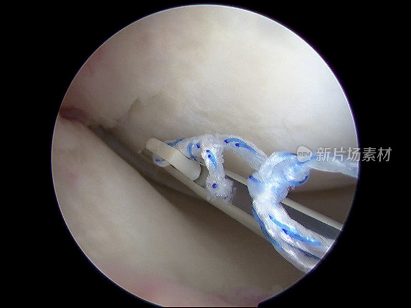 膝关节全内半月板修复的关节镜观察