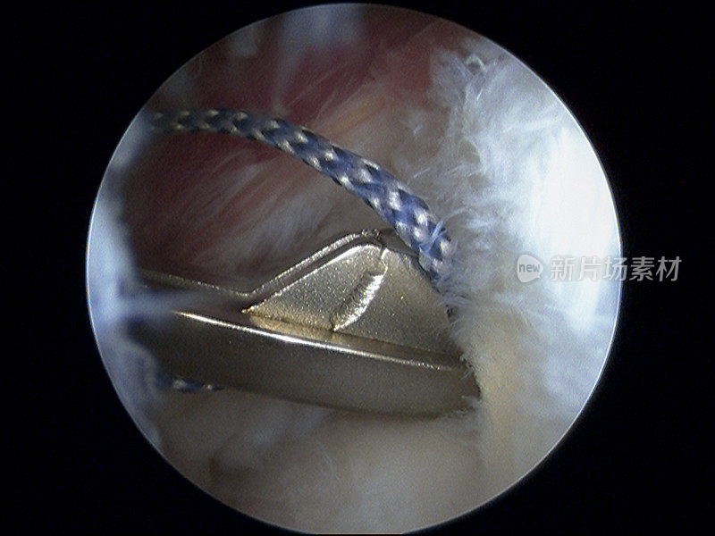 肩关节镜下肩袖修补术中的缝合穿过装置