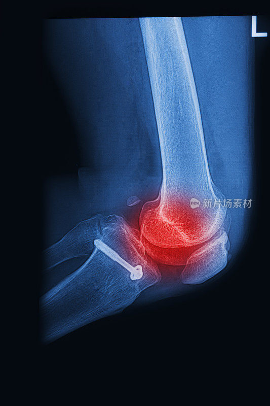 X光片显示骨折的膝关节植入物