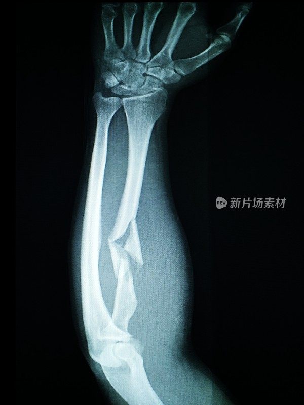 x射线前臂骨折。