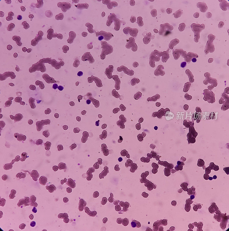 冷凝集素病，红细胞在低温下聚集(凝集)，自身免疫性溶血性贫血，红细胞各向异性染色，可见大细胞棘突细胞。macrocytic贫血。