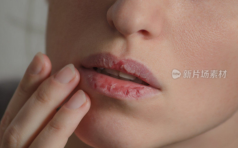 Dermatillomania皮肤挑选。女人有舔嘴唇的坏习惯。由焦虑、压力和嘴唇干燥导致的有害成瘾。剥皮障碍。生病的、开裂的、受损的组织。