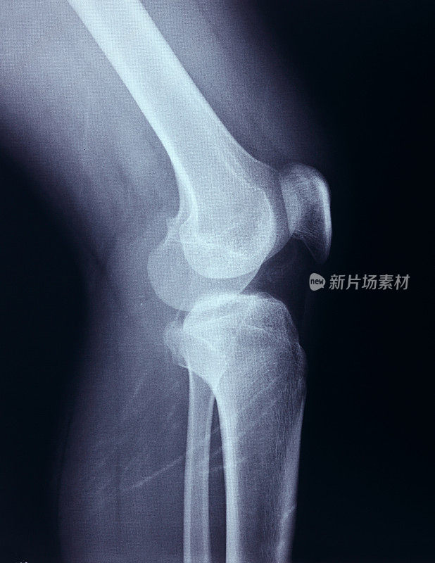 膝关节x光骨人类腿部解剖学