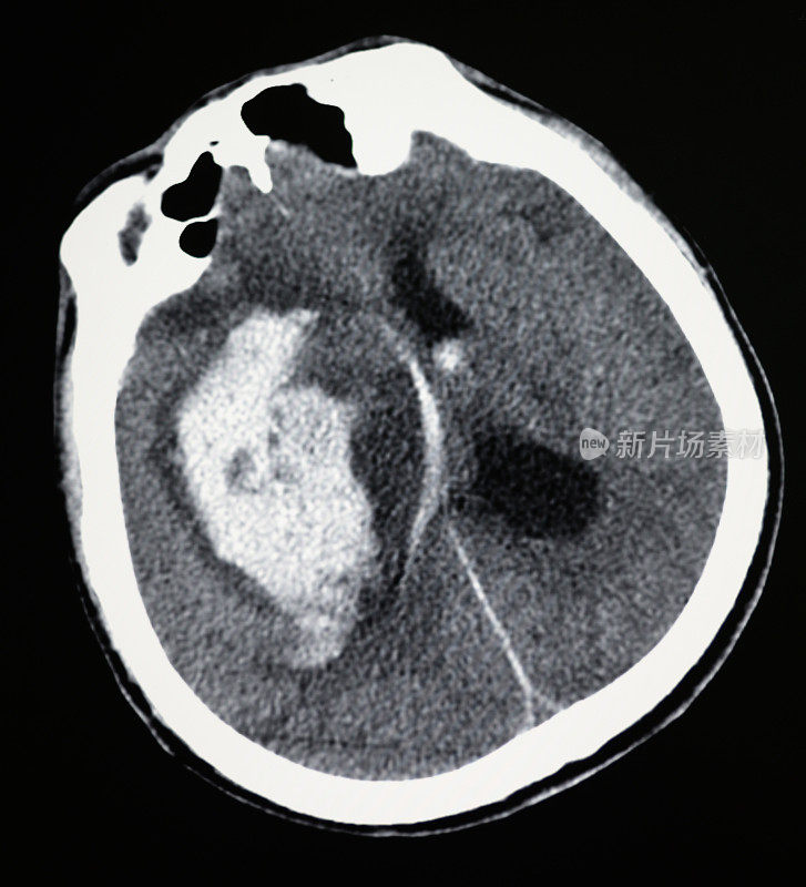 脑膜瘤显示在头部CT影像