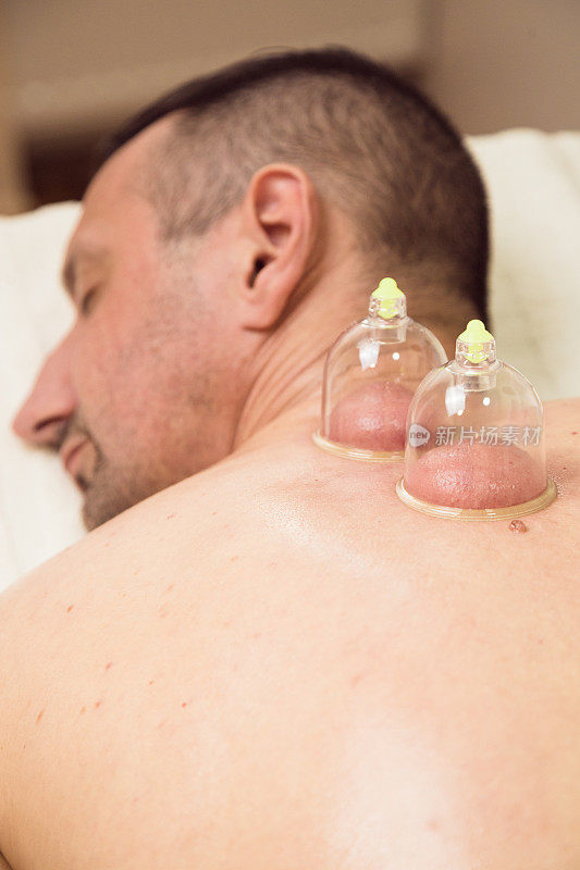 Hijama，湿罐疗法。真实治疗图像，药物出血敏感内容