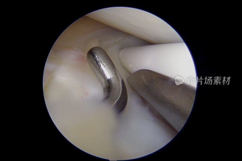 膝关节半月板全内修复的关节镜视图