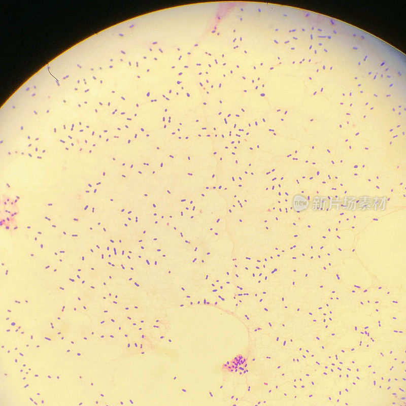 显微镜下的肺炎球菌脑膜炎