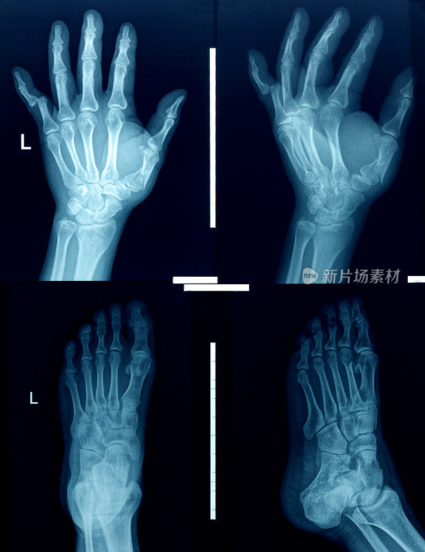 手和脚的x光图像