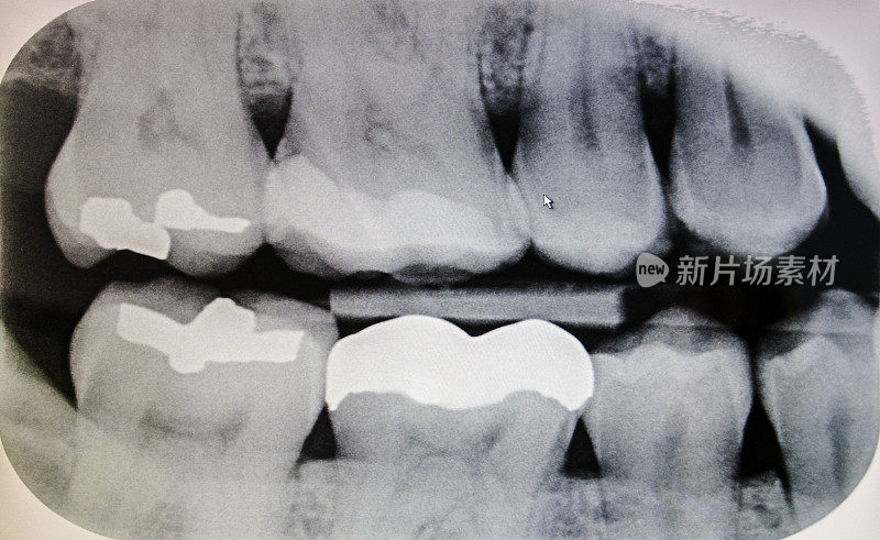 牙齿x射线图像