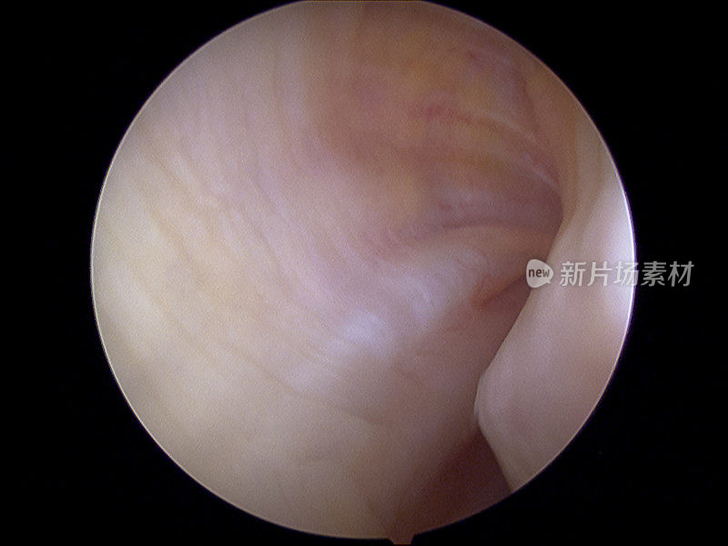 左膝内侧沟的关节镜图