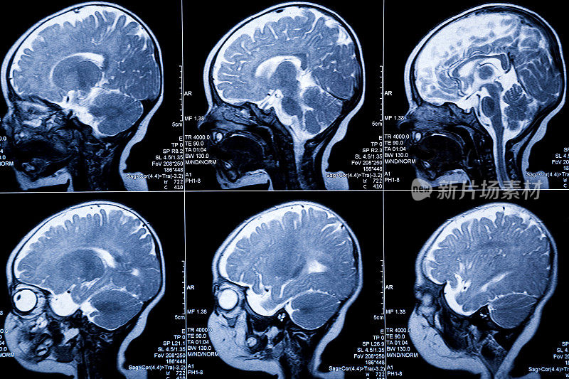 婴儿MRI脑部扫描:脑白质病变和发育异常