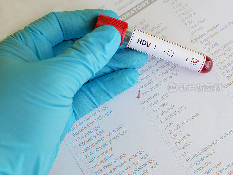 丁型肝炎病毒(HDV)阳性