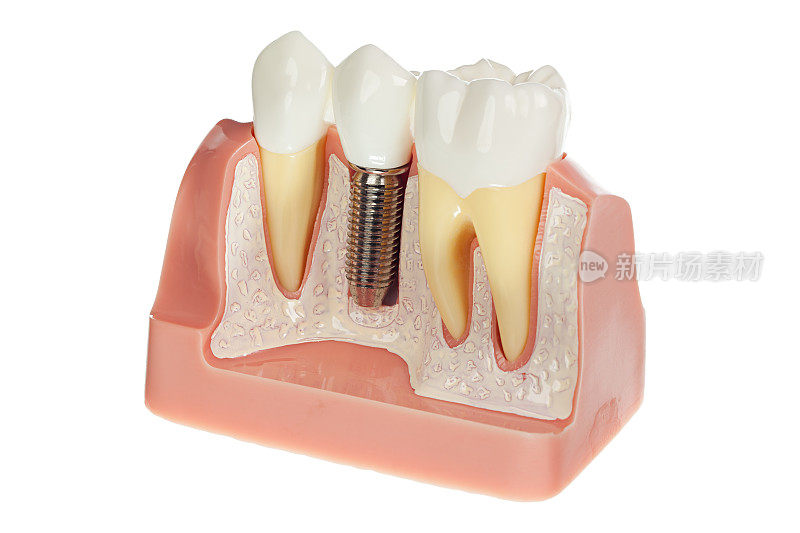3D渲染的牙科种植放置