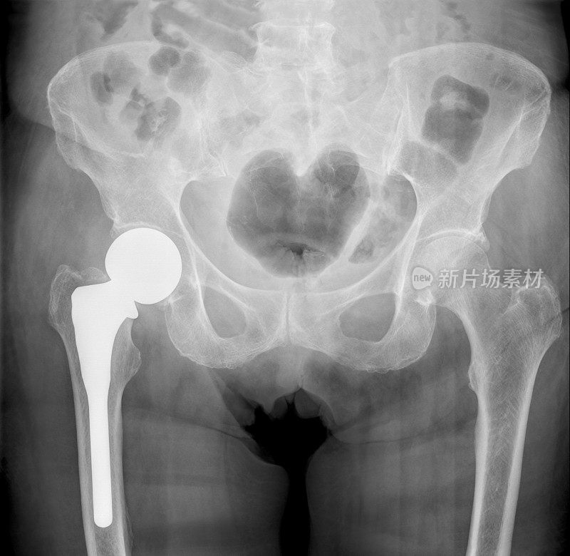 骨盆x光片显示右侧股骨半关节成形术