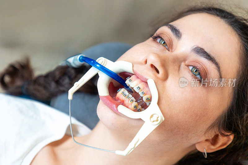 白人妇女的俯视图肖像与牙齿上的拉环托架与牵开器。正畸学和口腔医学的概念