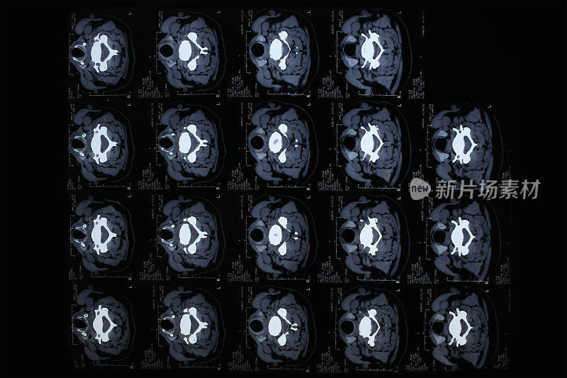 脊柱ct扫描