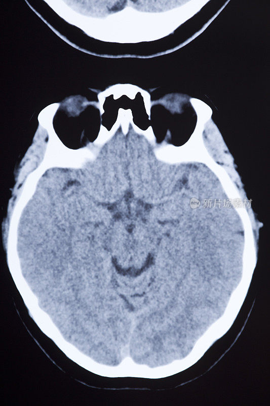 医学MRI图像显示大脑和头骨